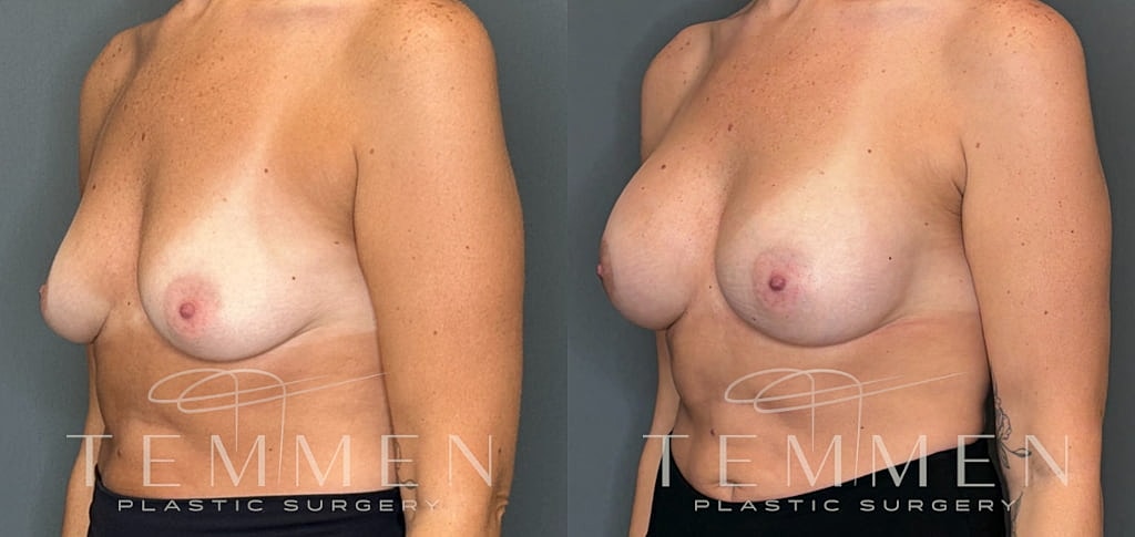 Breast Augmentation Before & After