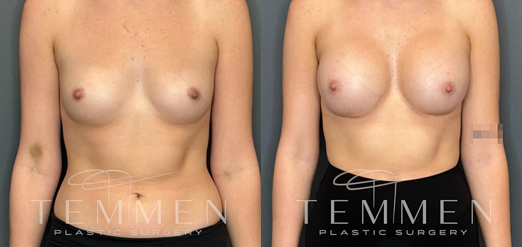 Breast Augmentation Before & After