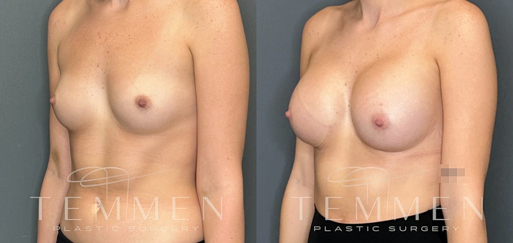 Breast Augmentation Before & After
