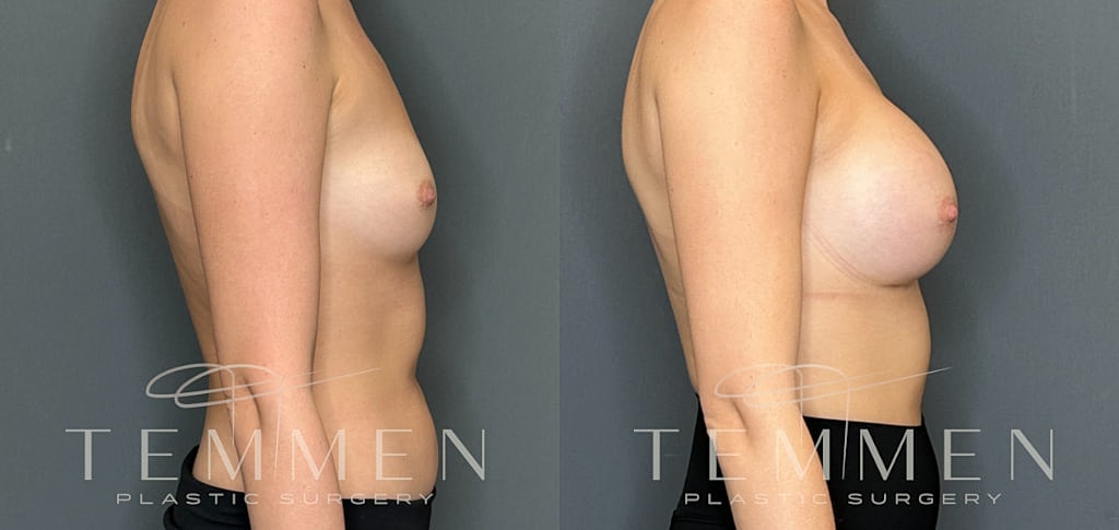 Breast Augmentation Before & After