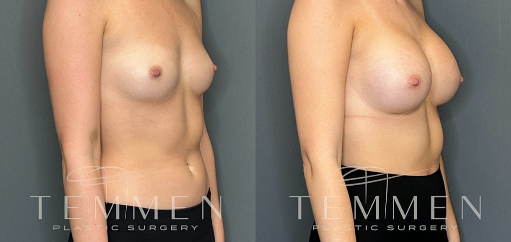 Breast Augmentation Before & After