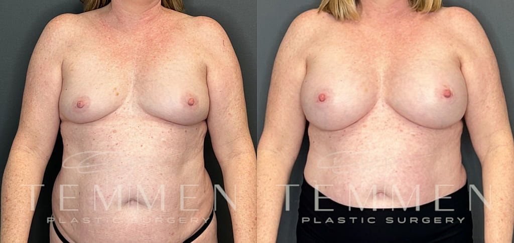 Breast Augmentation Before & After
