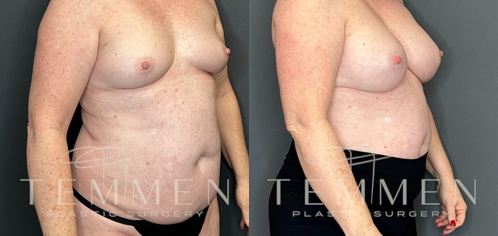 Breast Augmentation Before & After