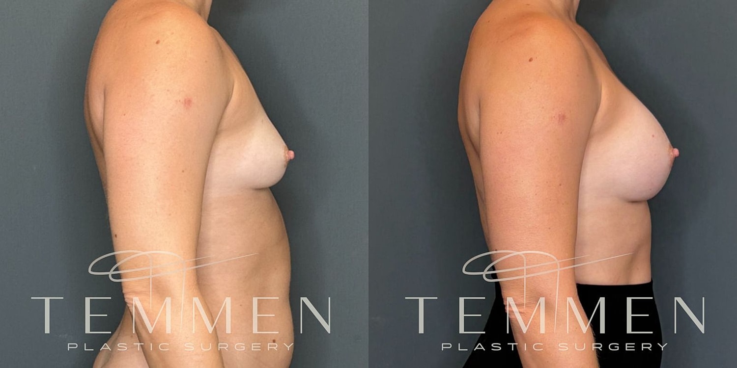 Breast Augmentation Before & After