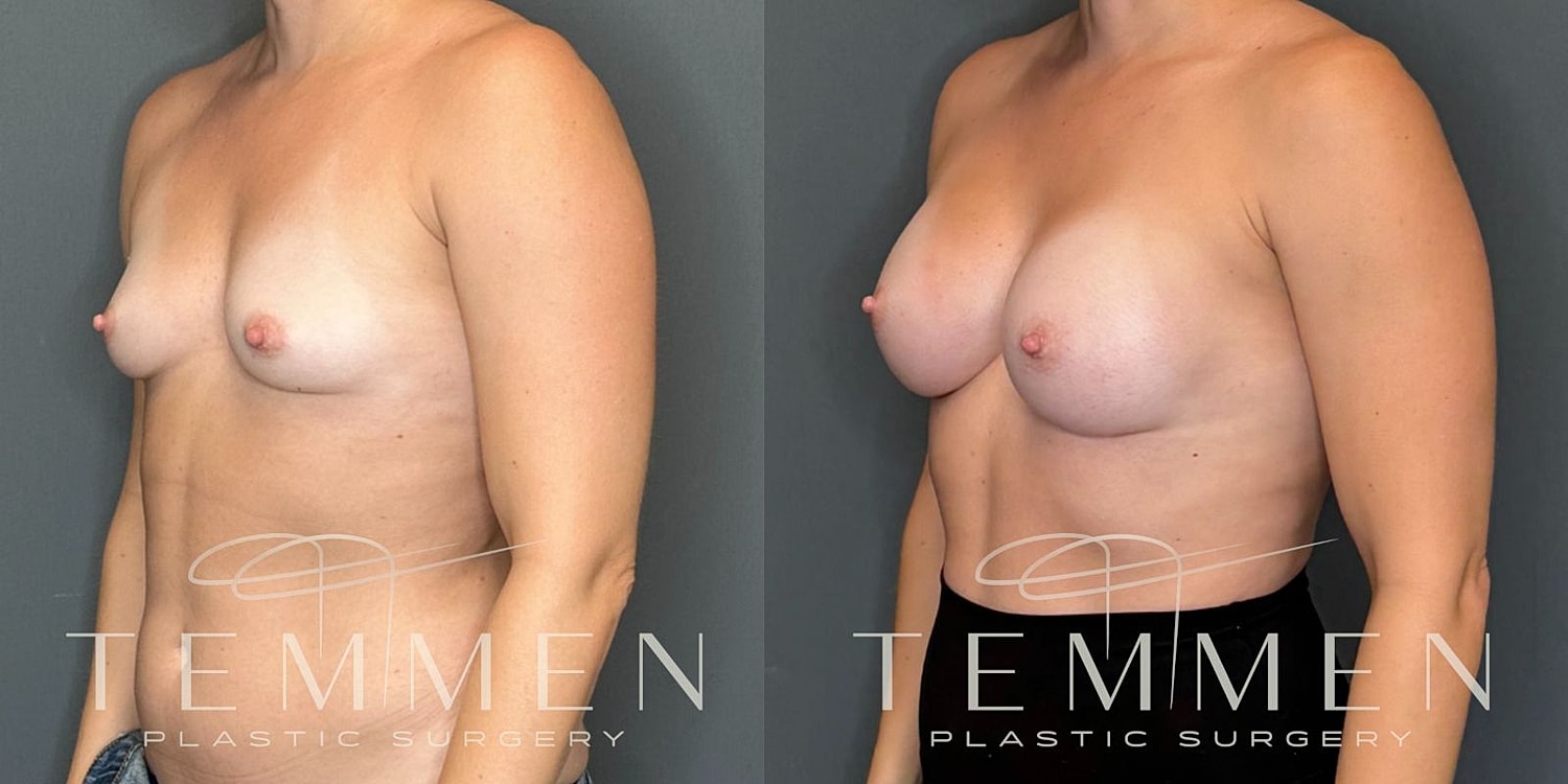 Breast Augmentation Before & After