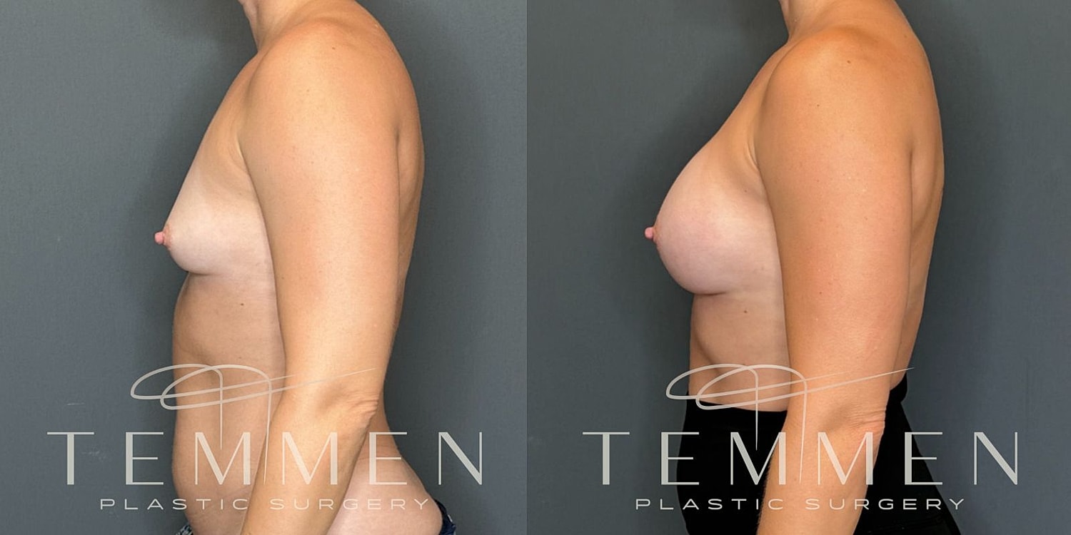 Breast Augmentation Before & After