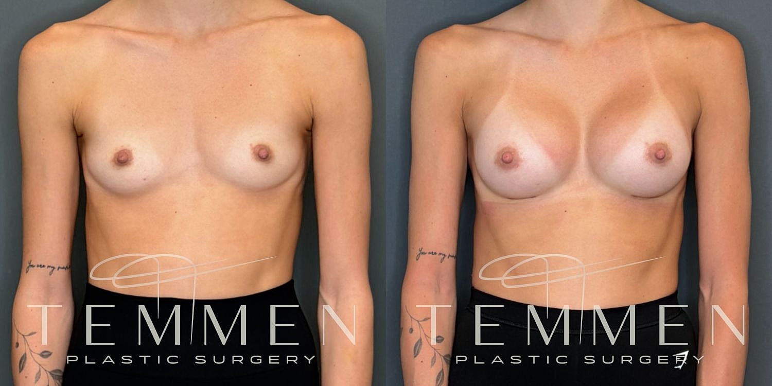 Breast Augmentation Before & After