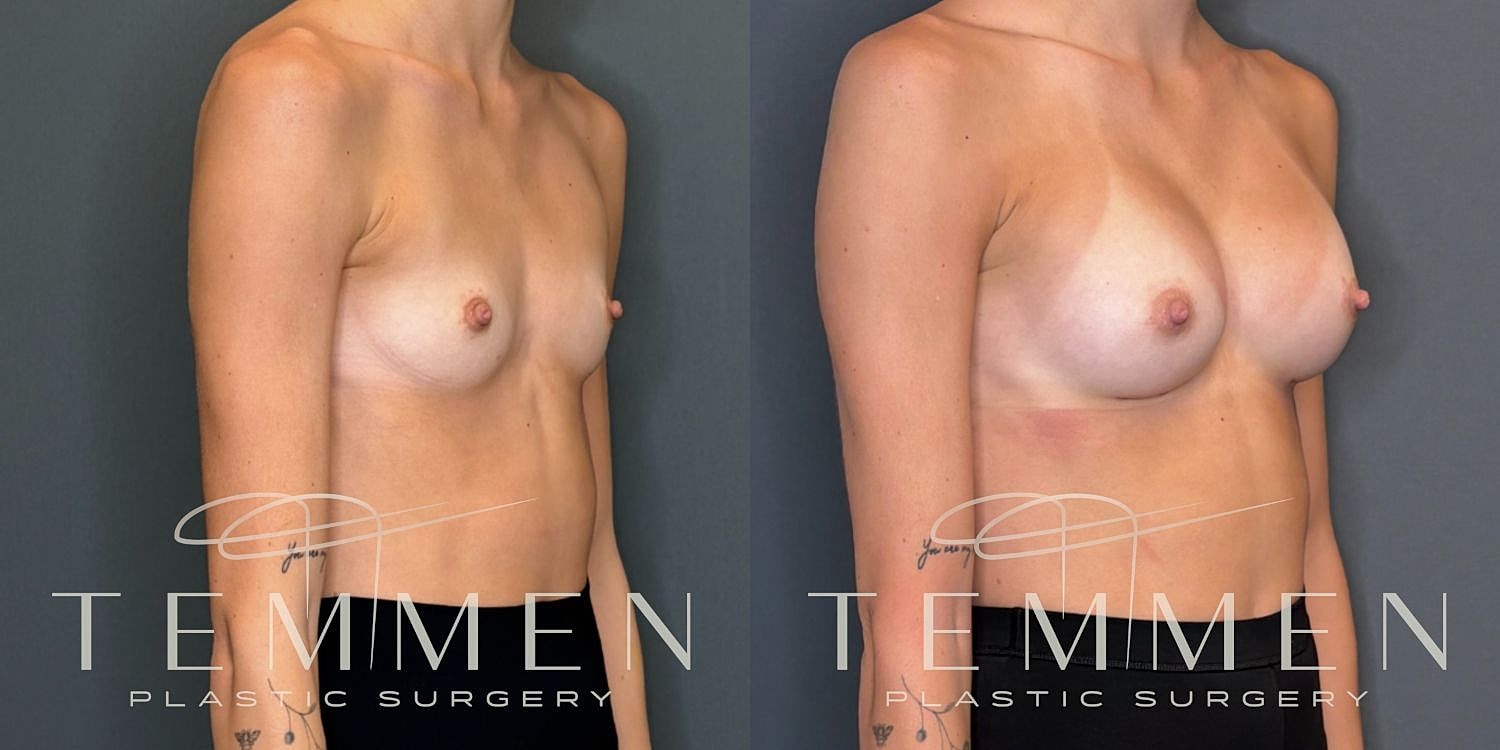 Breast Augmentation Before & After