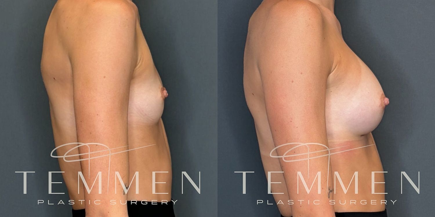Breast Augmentation Before & After