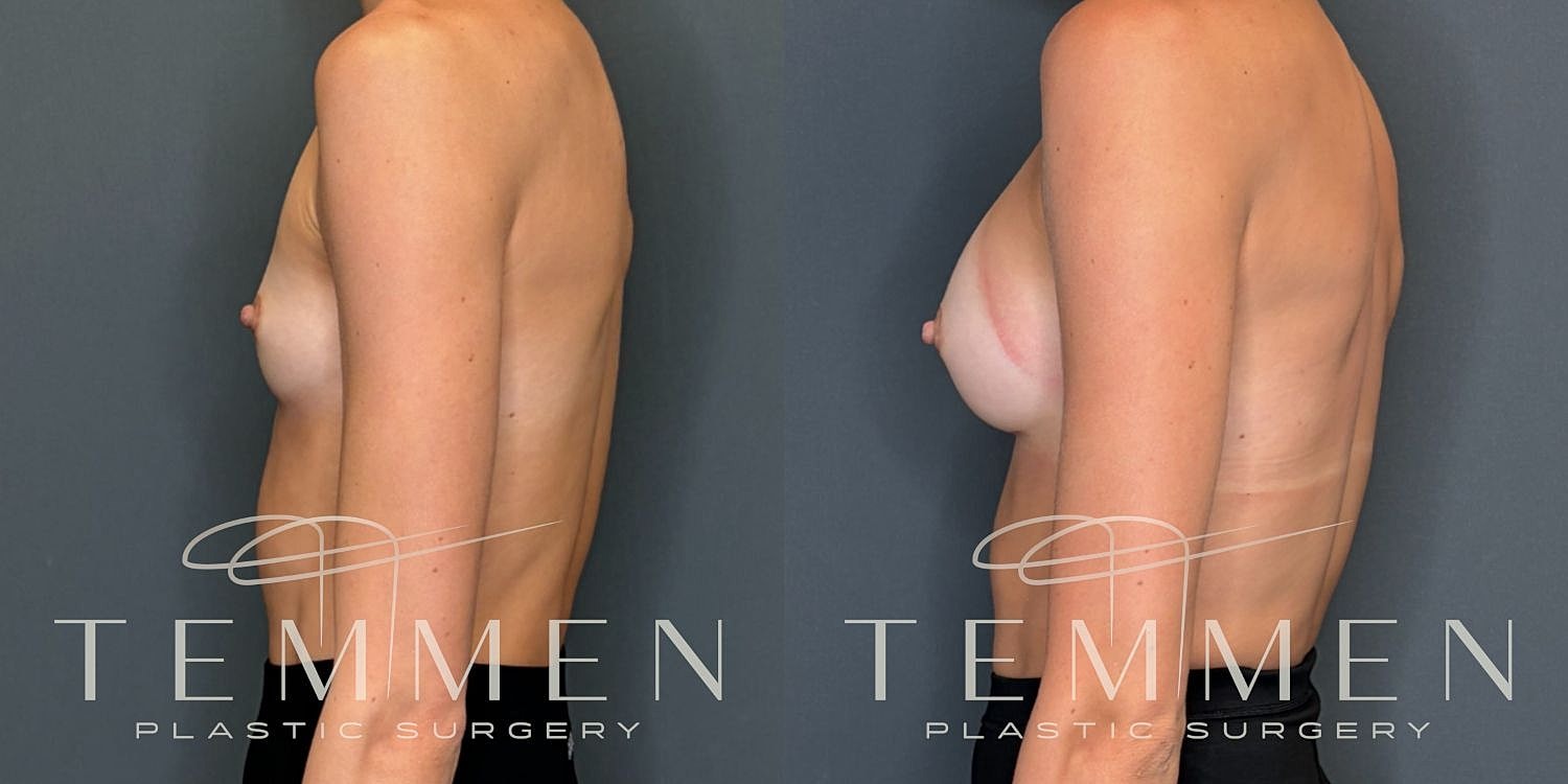 Breast Augmentation Before & After