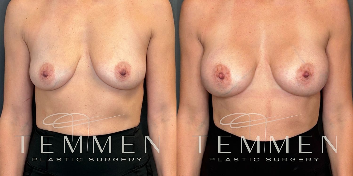 Breast Augmentation Before & After