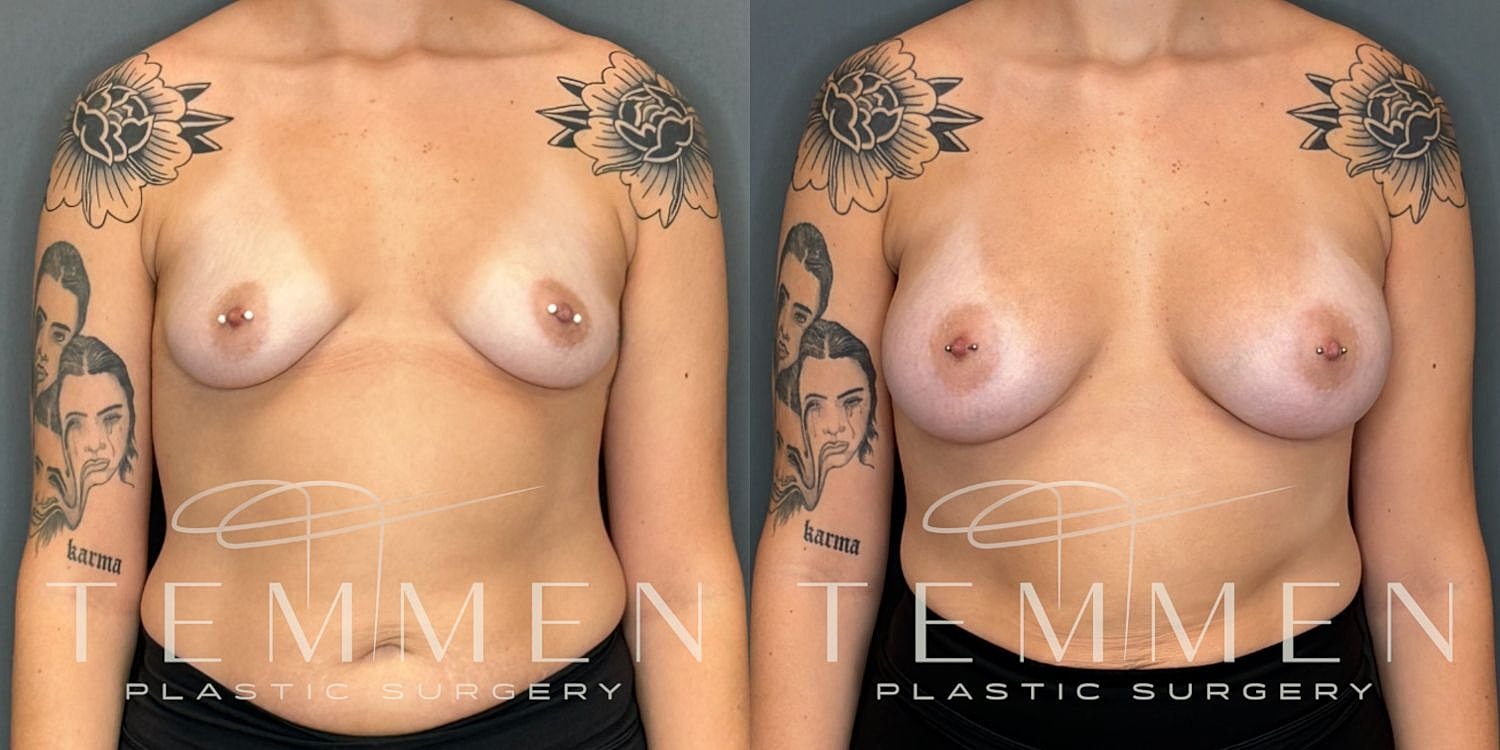 Breast Augmentation Before & After