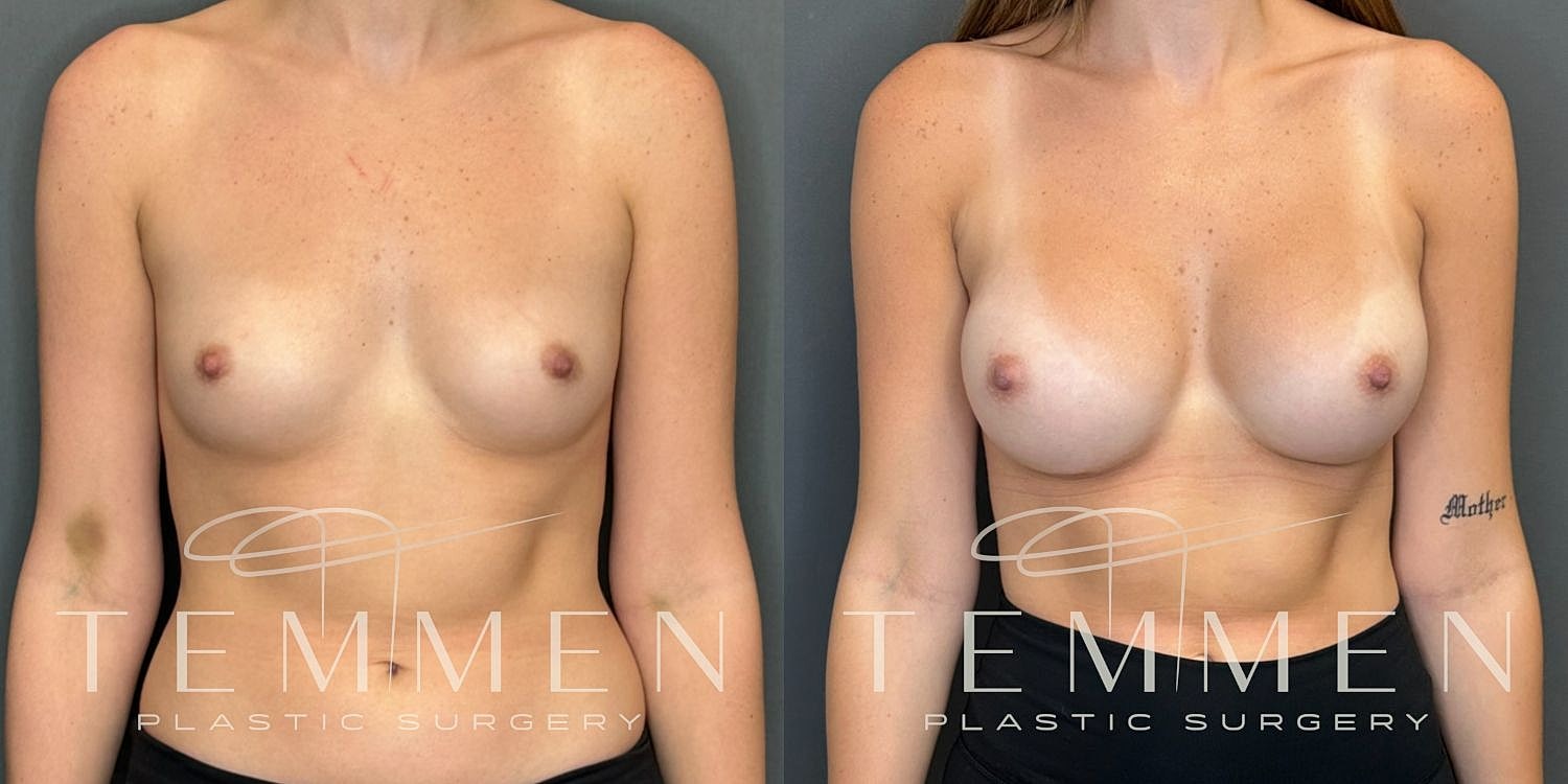 Breast Augmentation Before & After