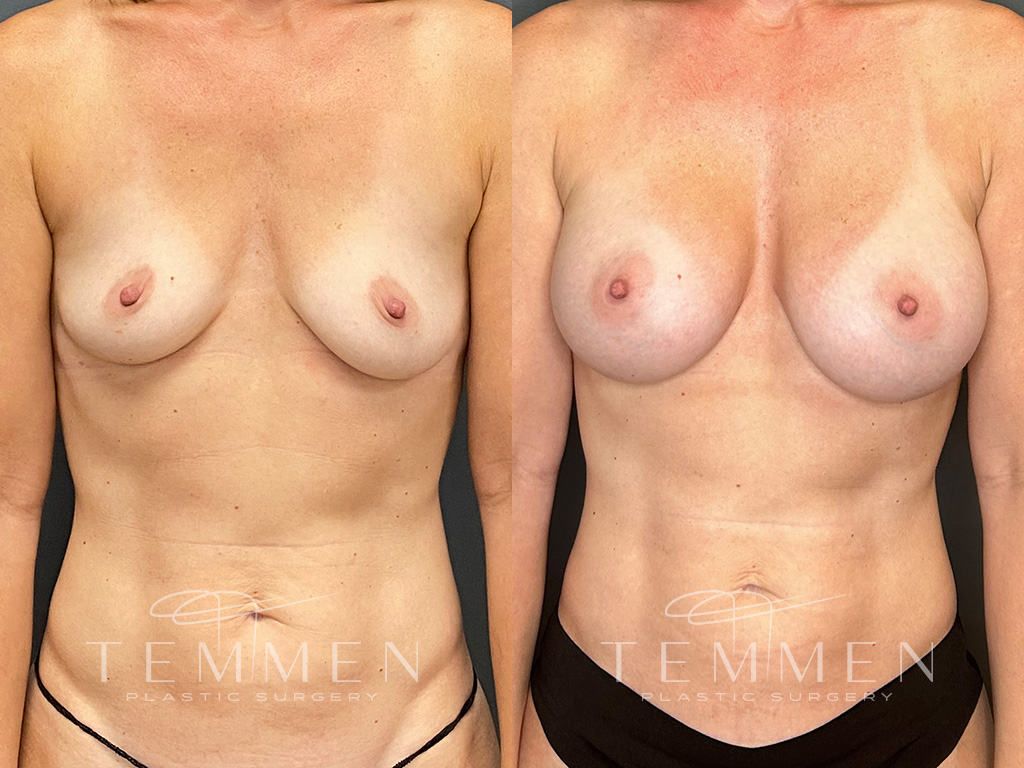 Breast Augmentation Before & After