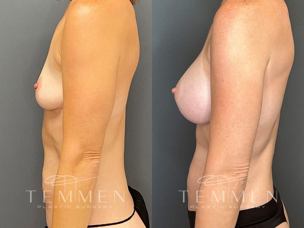 Breast Augmentation Before & After