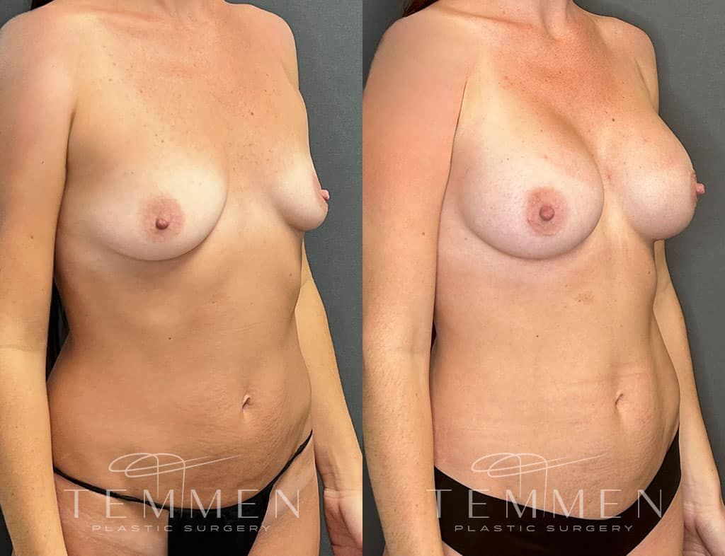 Breast Augmentation Before & After