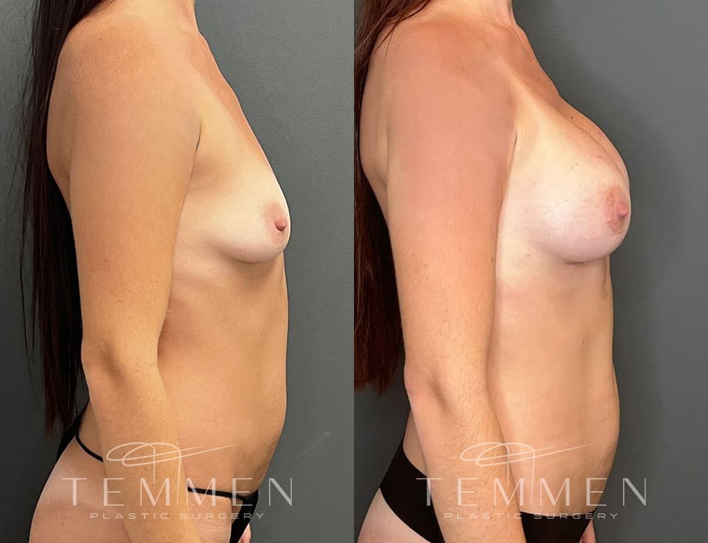 Breast Augmentation Before & After