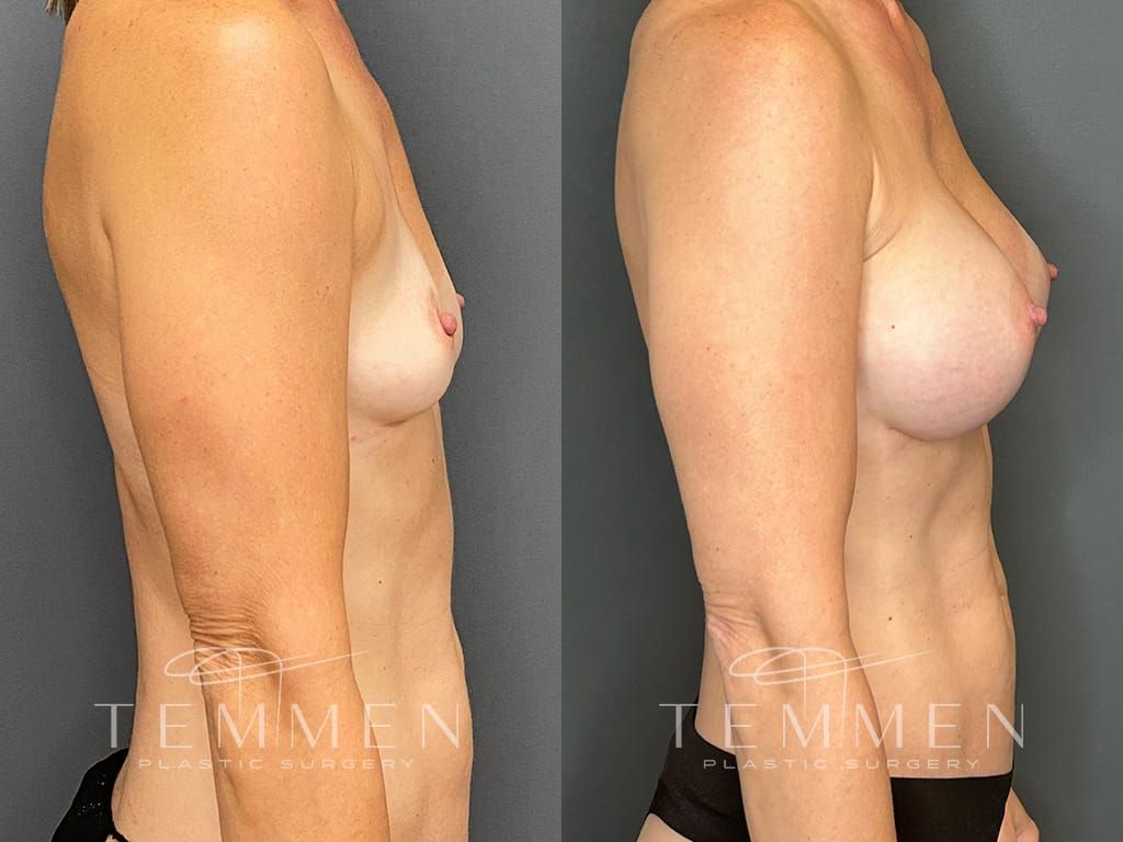 Breast Augmentation Before & After
