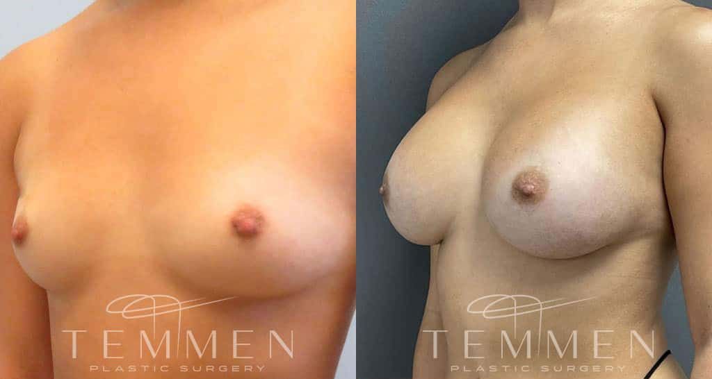 Breast Augmentation Before & After