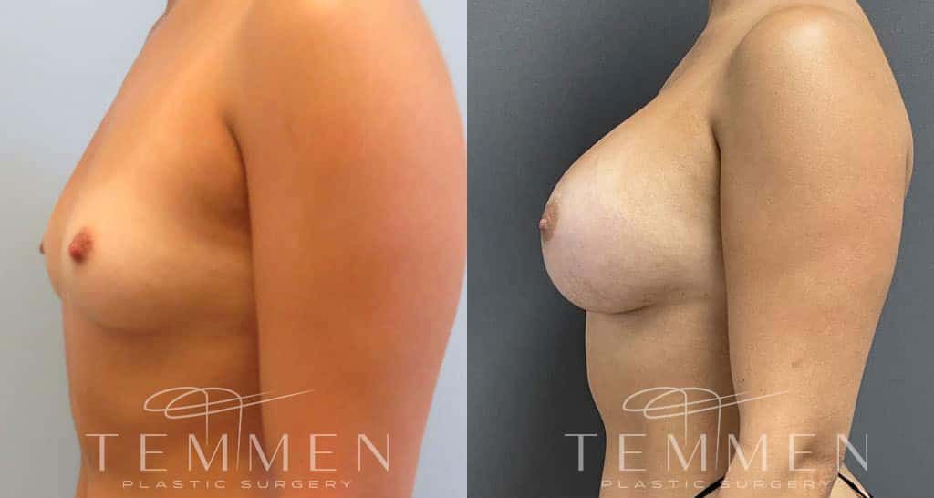Breast Augmentation Before & After