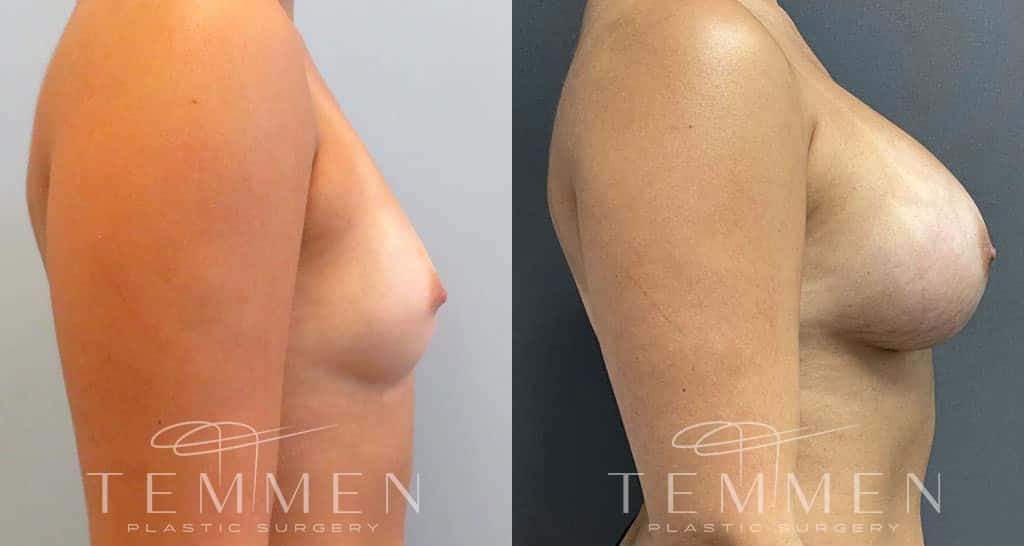 Breast Augmentation Before & After