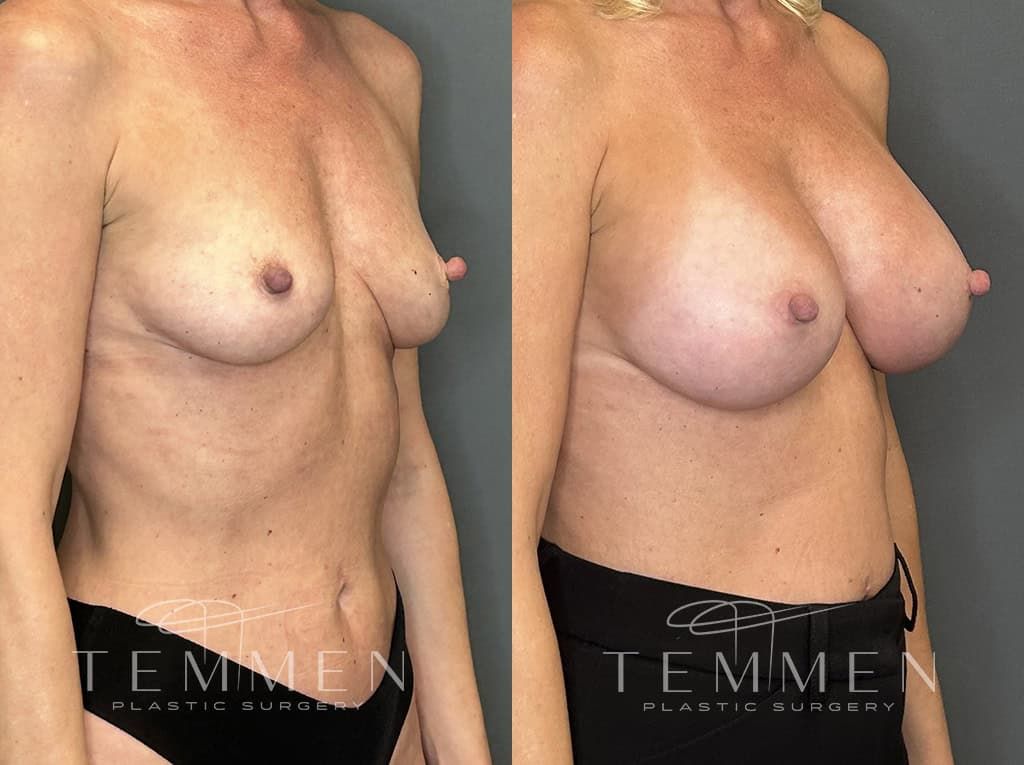 Breast Augmentation Before & After