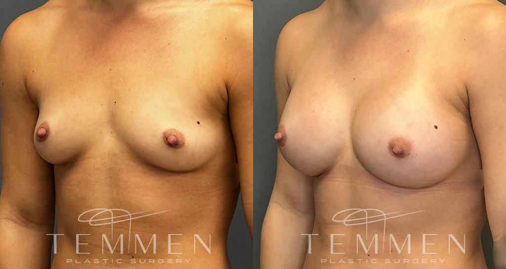 Breast Augmentation Before & After
