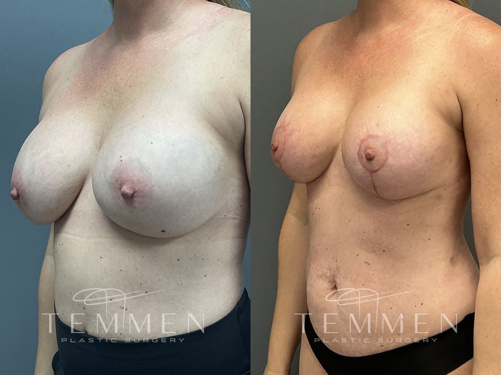 Breast Augmentation Revision Before & After