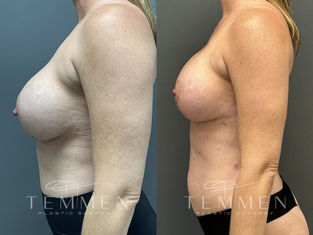 Breast Augmentation Revision Before & After