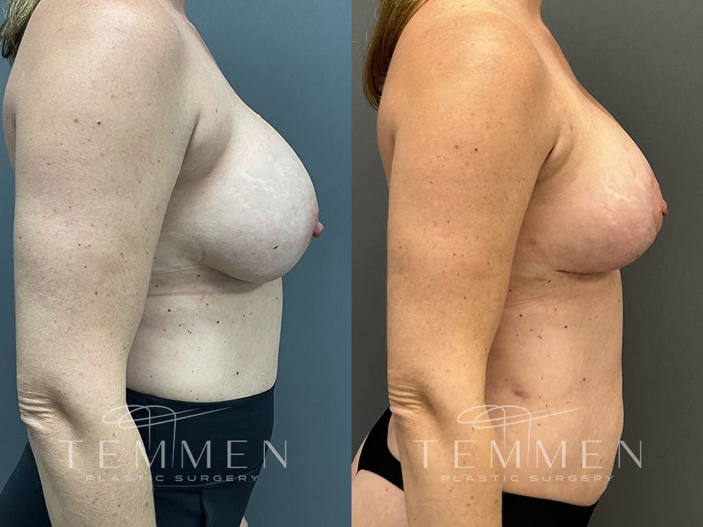 Breast Augmentation Revision Before & After