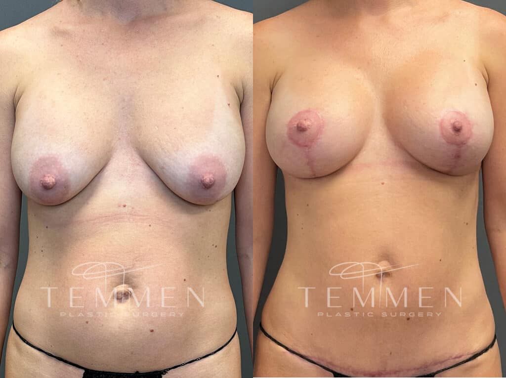 Breast Augmentation Revision Before & After
