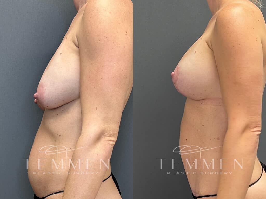 Breast Augmentation Revision Before & After