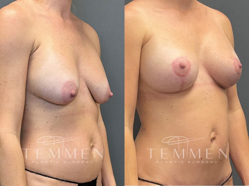 Breast Augmentation Revision Before & After