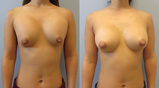 Breast Augmentation Revision Before & After