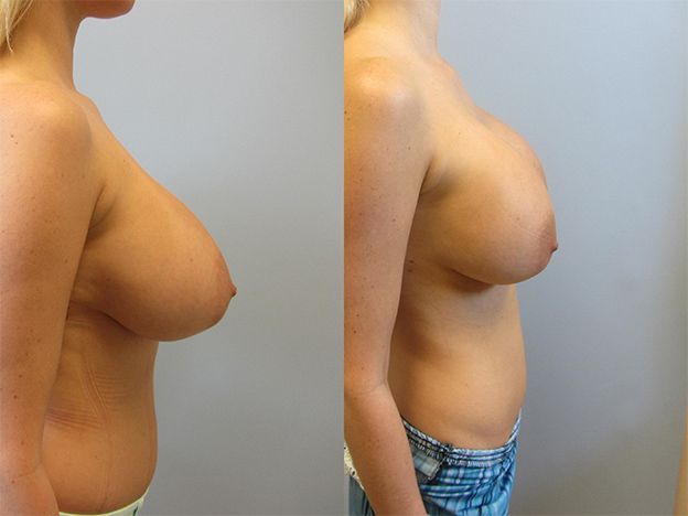 Breast Augmentation Revision Before & After