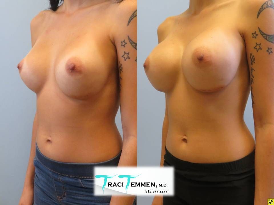 Breast Augmentation Revision Before & After