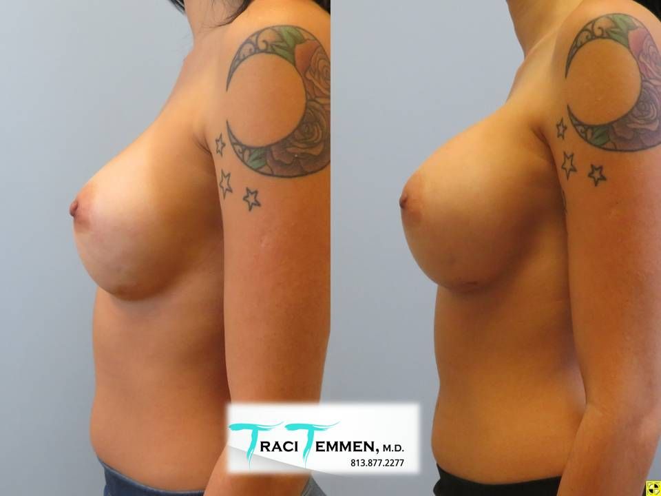 Breast Augmentation Revision Before & After