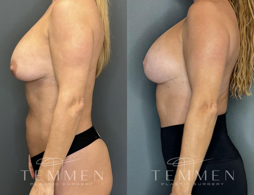 Breast Augmentation Revision Before & After