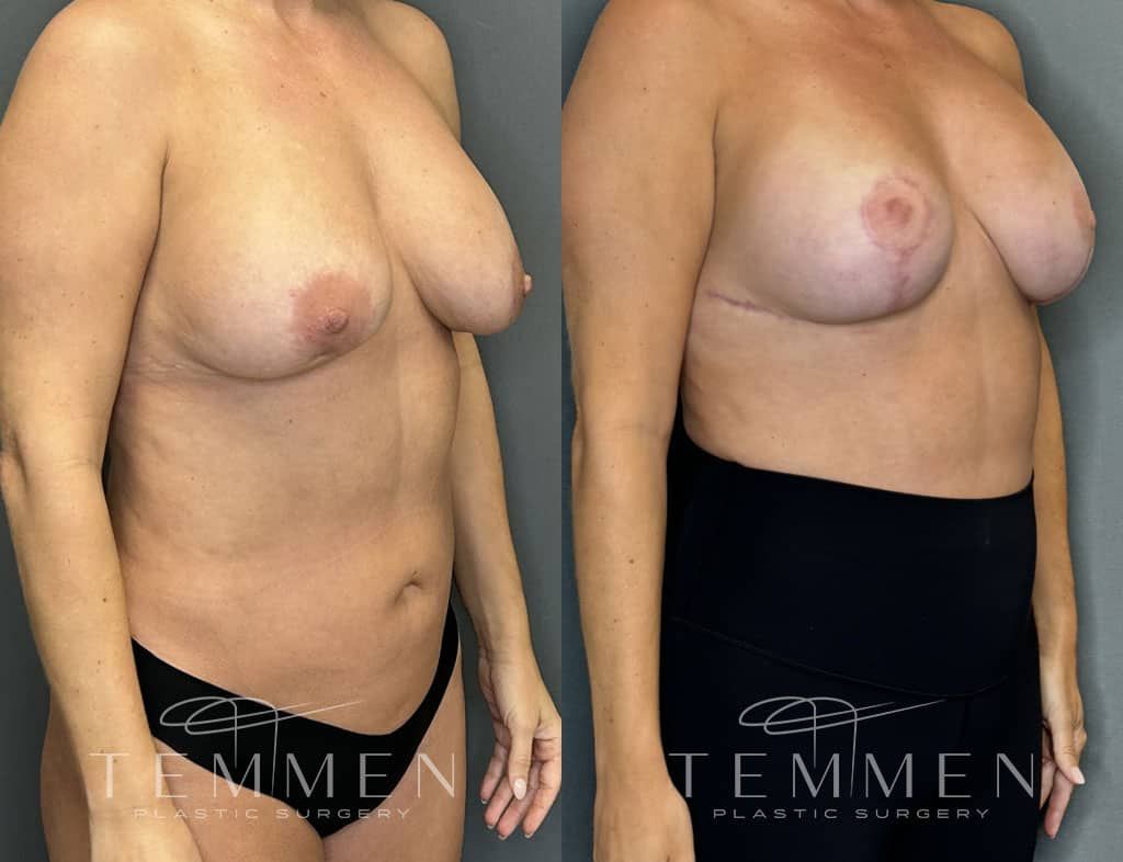 Breast Augmentation Revision Before & After