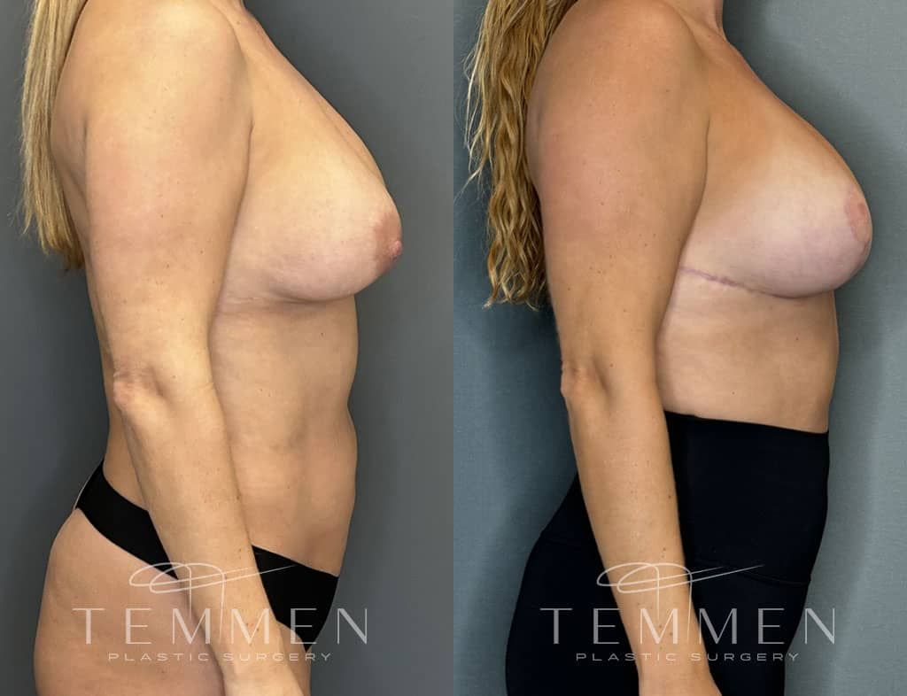 Breast Augmentation Revision Before & After