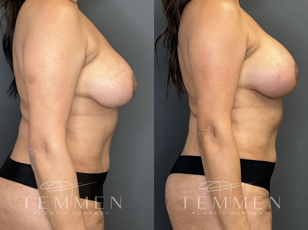 Breast Augmentation Revision Before & After