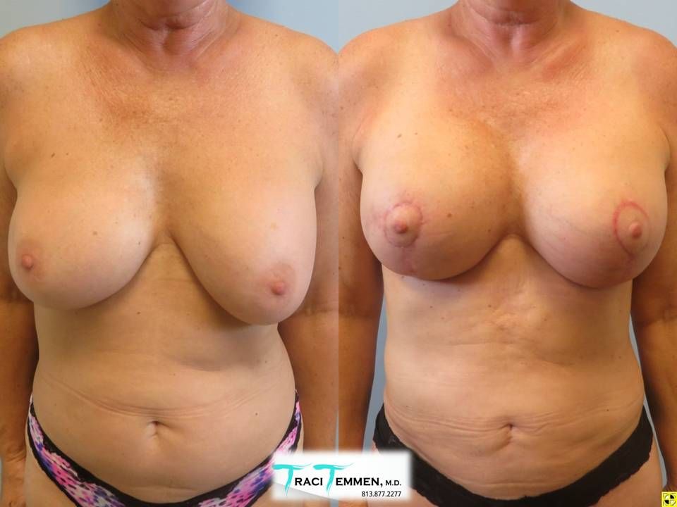 Breast Augmentation Revision Before & After