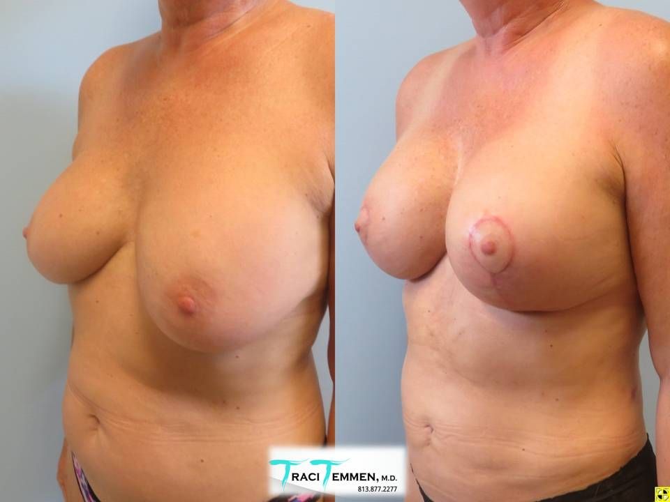 Breast Augmentation Revision Before & After