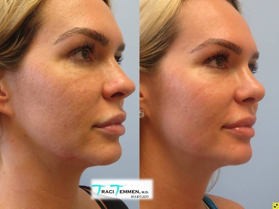 Rhinoplasty Before & After