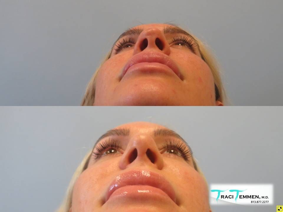 Rhinoplasty Before & After