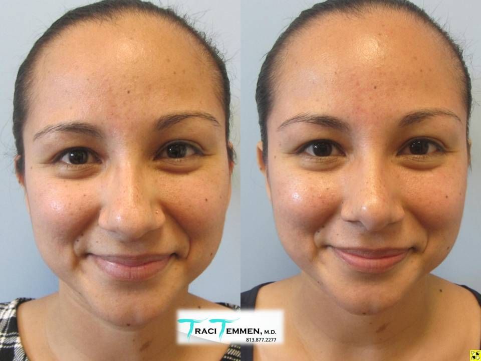 Rhinoplasty Before & After