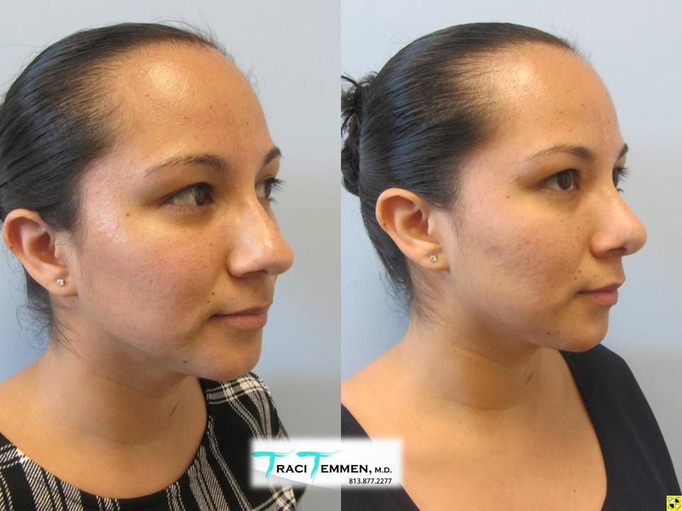 Rhinoplasty Before & After