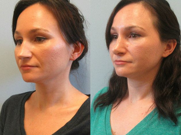 Rhinoplasty Before & After