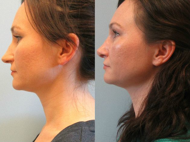 Rhinoplasty Before & After