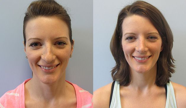 Rhinoplasty Before & After